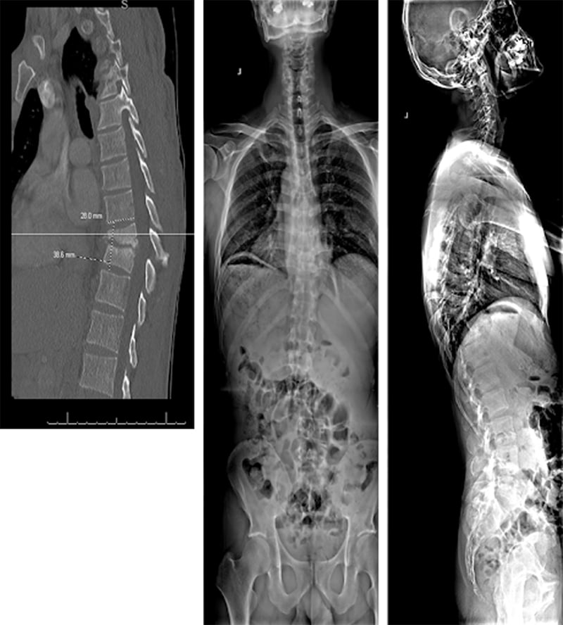 Pillow of Scoliosis of the spine, X-ray C016 / 6566