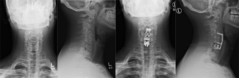 Spinal Fusion Manhattan NYC Long Island