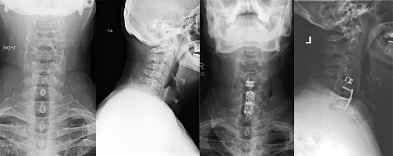 Degenerative Cervical Spine with Posterior Fusion