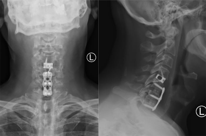 How Long After Anterior Cervical Discectomy And Fusion - Infoupdate.org