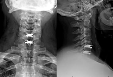 cervical disc replacement procedure