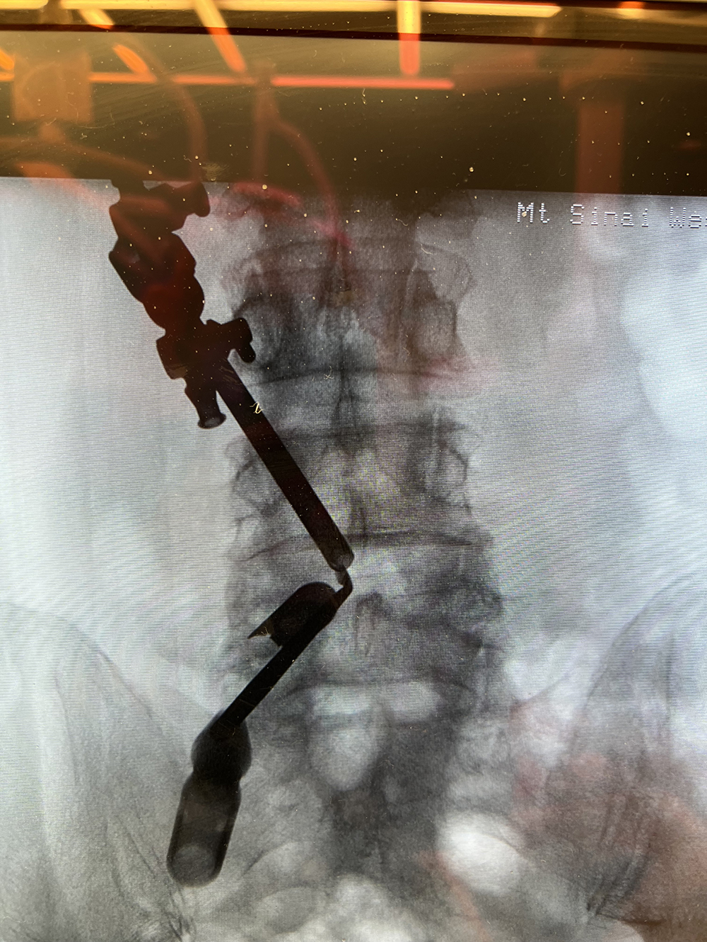 Endoscopic Spine Surgery Manhattan NYC Long Island